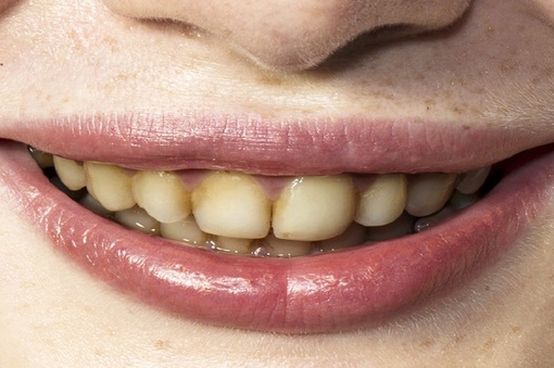 牙医:搞错顺序难怪你一口黄牙|每日健康 health